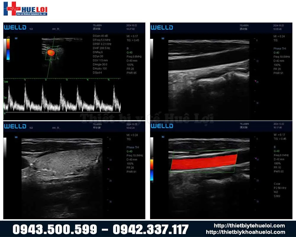 Chất lượng hình ảnh thực tế máy siêu âm xách tay p10