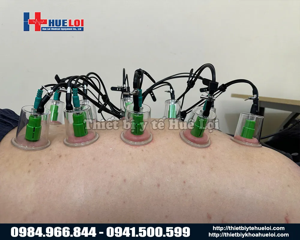 Cốc điện châm giác hút máy điện châm không kim