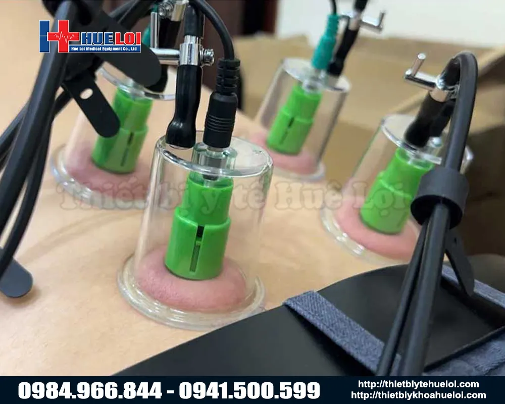 Điện châm kết hợp giác hút