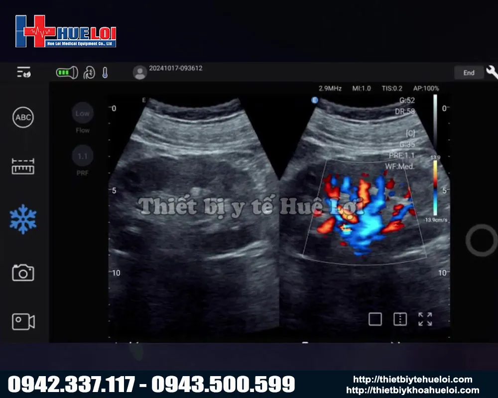 hình ảnh thực tế được thực hiện trên máy siêu âm di động edan nano c5 exp