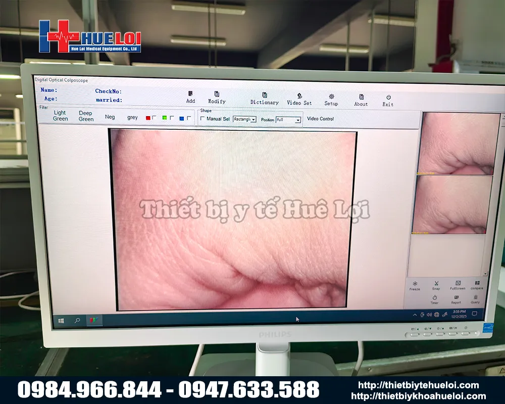 Máy soi cổ tử cung sd sanwe
