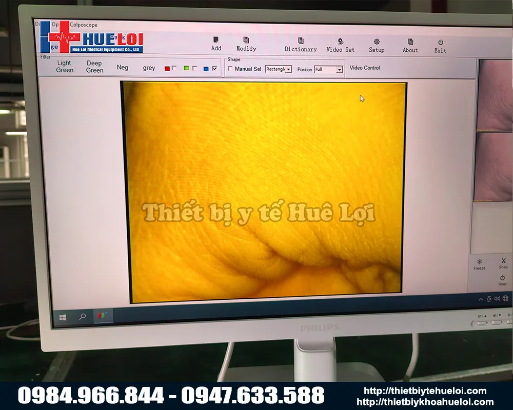 Chất lượng hình ảnh máy soi cổ tử cung cao cấp