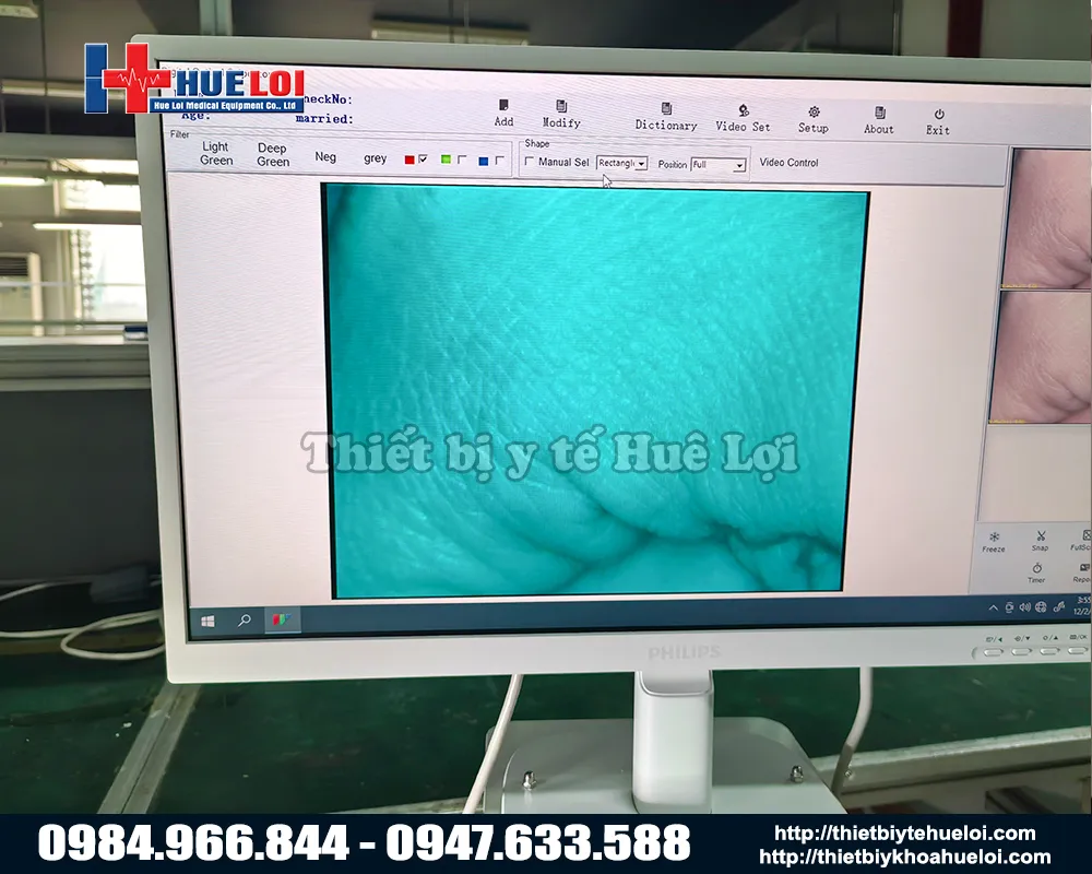 Chất lượng hình ảnh máy soi cổ tử cung sanwe sw302